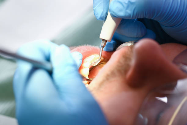 Best Emergency Tooth Extraction in Lake Of The Woods, IL