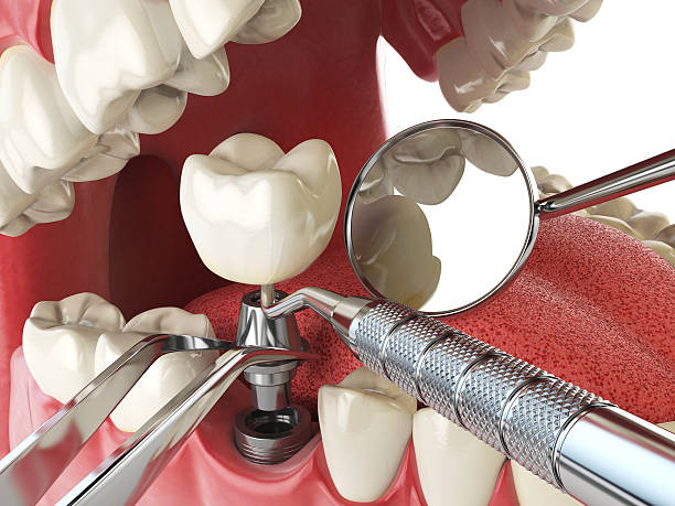 Best Emergency Dental Care for Broken or Chipped Teeth in Lake Of The Woods, IL